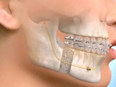 Oral Maxillofacial Surgery